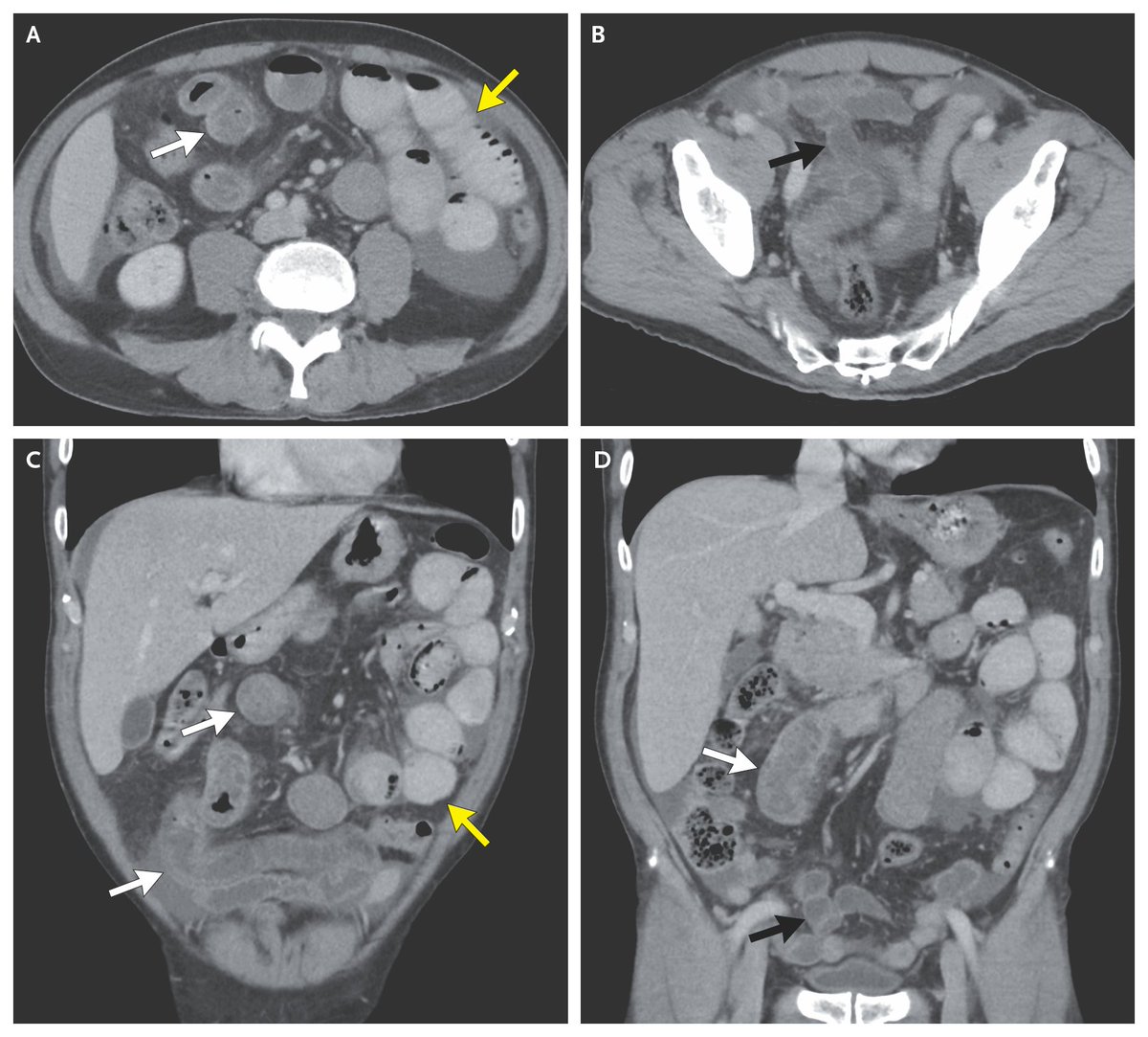 NEJM's tweet photo. Case Record of the Massachusetts General Hospital (@MassGeneralNews): A 65-Year-Old Man with Fever and Rash https://t.co/T3Iwp47QWa 

#Dermatology #InfectiousDisease https://t.co/UKfGfdThn6