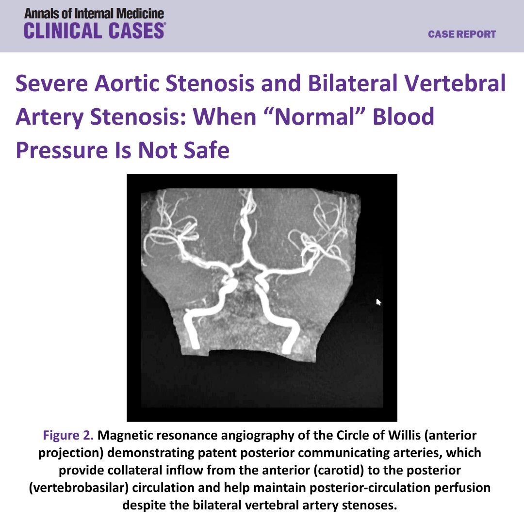 AnnalsofIMCC's tweet photo. A 62-year-old woman experienced recurrent fainting episodes, double vision, eyelid drooping, and weakness. Although her blood pressure appeared normal and MRI showed no acute stroke, her symptoms were caused by vertebrobasilar hypoperfusion from severe aortic stenosis and bilateral vertebral artery stenosis. Read the full text for free here: https://t.co/A7jd90sHxM @AHAScience #AHAJournals @sarmisakkafa