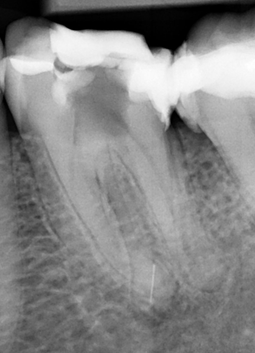 VyROnSq's tweet photo. Referral after separated file on a radix entomolaris. CBCT revealed that fractured file was inside the sharply curved narrow root and not outside in bone. A decision was made to attempt bypassing the fragment and communicating with lesion in a non surgical approach. https://t.co/RXDQopfARx
