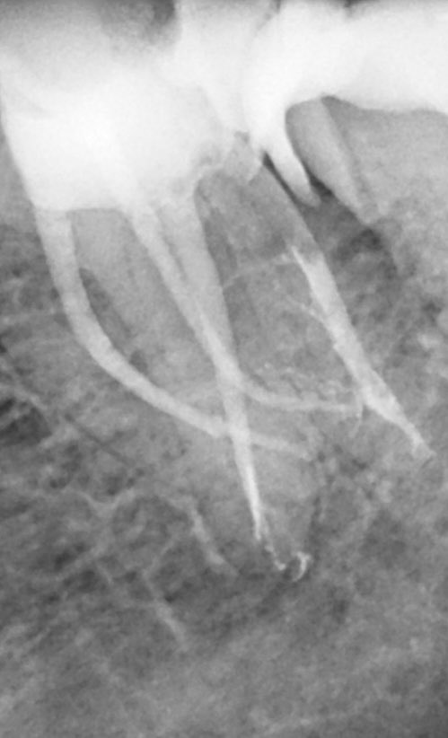 VyROnSq's tweet photo. Referral after separated file on a radix entomolaris. CBCT revealed that fractured file was inside the sharply curved narrow root and not outside in bone. A decision was made to attempt bypassing the fragment and communicating with lesion in a non surgical approach. https://t.co/RXDQopfARx
