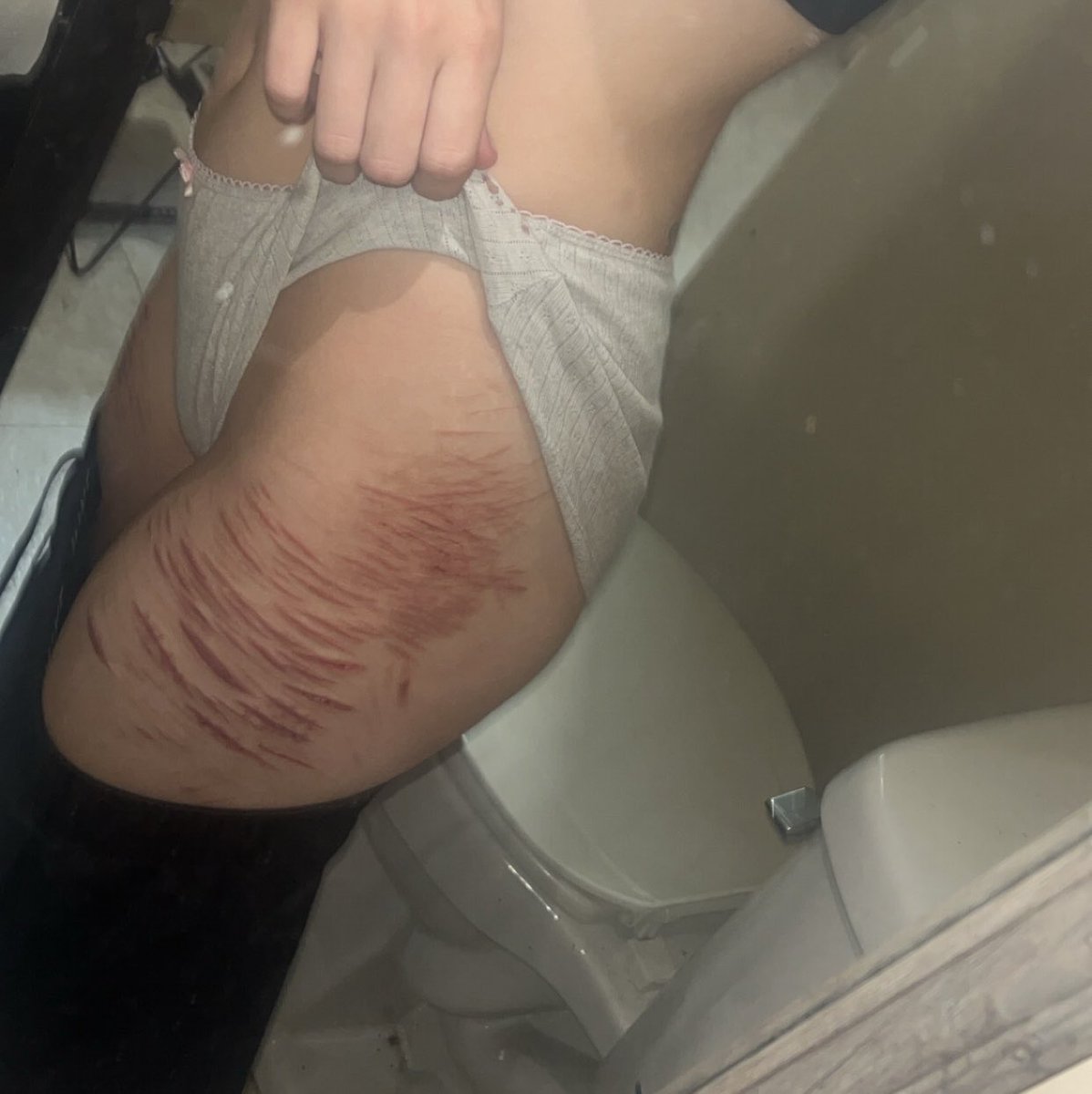bloodybeauty_x's tweet photo. am I scarspo or do I need help?

ACTUAL HEALED SCAR SFX MAKEUP!! not real skin, model leg, silicone skin and latex scars!! [ ‼️COMPLETELY FAKE, PROFESSIONAL SFX MAKEUP ENHANCED BY AI‼️ ]

🏷️: shedtwt sledtwt shtwt slittwt slitter edtwt ouchietwt shrtwt sh https://t.co/mquyWP0UI3