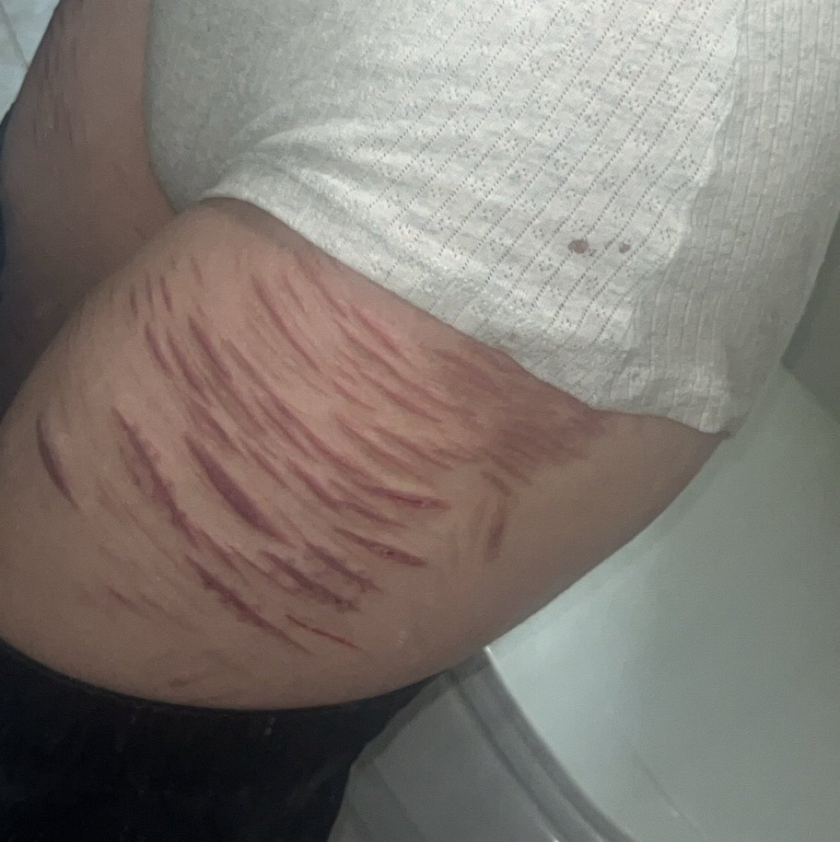 bloodybeauty_x's tweet photo. am I scarspo or do I need help?

ACTUAL HEALED SCAR SFX MAKEUP!! not real skin, model leg, silicone skin and latex scars!! [ ‼️COMPLETELY FAKE, PROFESSIONAL SFX MAKEUP ENHANCED BY AI‼️ ]

🏷️: shedtwt sledtwt shtwt slittwt slitter edtwt ouchietwt shrtwt sh https://t.co/mquyWP0UI3
