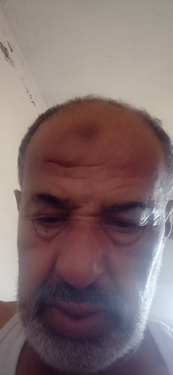 jamalmoh5995's tweet photo. My dear friends, I'm finding it difficult to move and I can't exert myself. I need to continue taking my medication. Please, I urgently need this medicine; it only costs $100 and I can get it. Please be there for me during this time. Thank you. 
https://t.co/FtjUpAlWtR https://t.co/eDwUpTwzPD