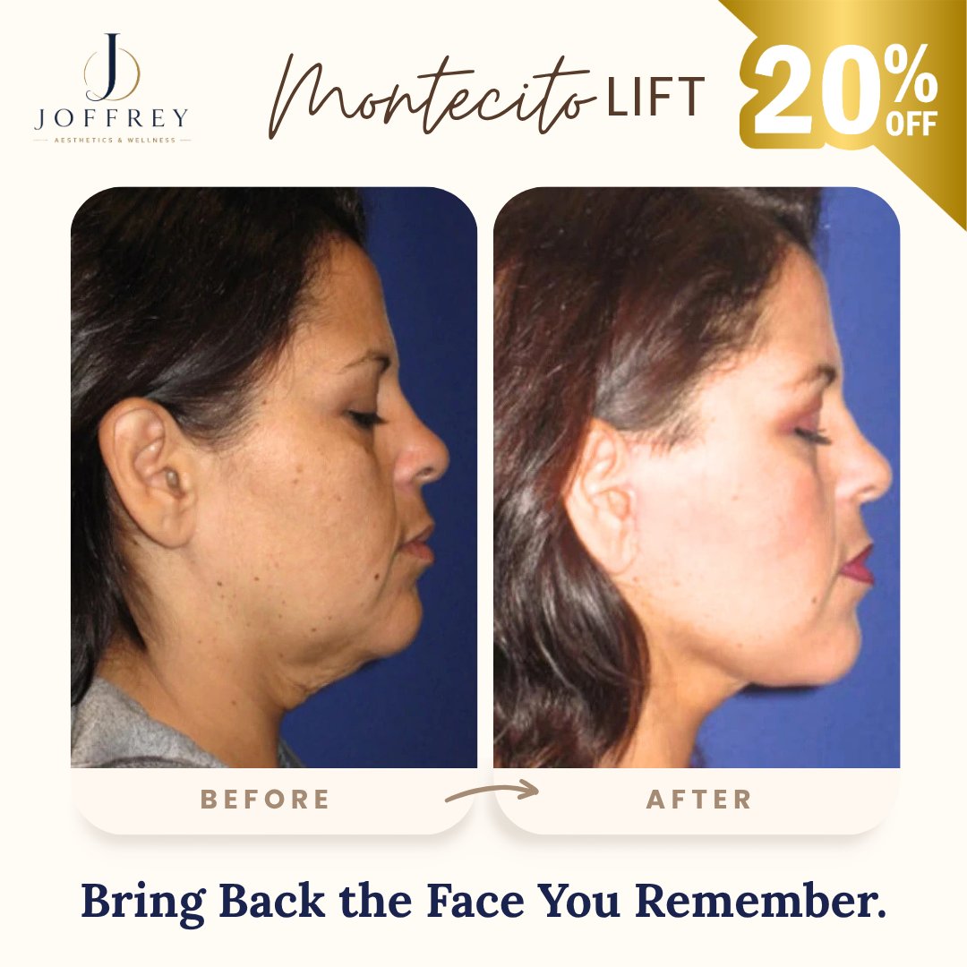joffaesthetics's tweet photo. A cleaner jawline. Reduced jowling. A smoother transition into the neck. And a face that still looks unmistakably like yours.

Book your free consultation:
https://t.co/9vxXAXL3PH

#Facelift #FacialRejuvenation #NaturalResults #SantaBarbara #Montecito https://t.co/90XCa6jfCd