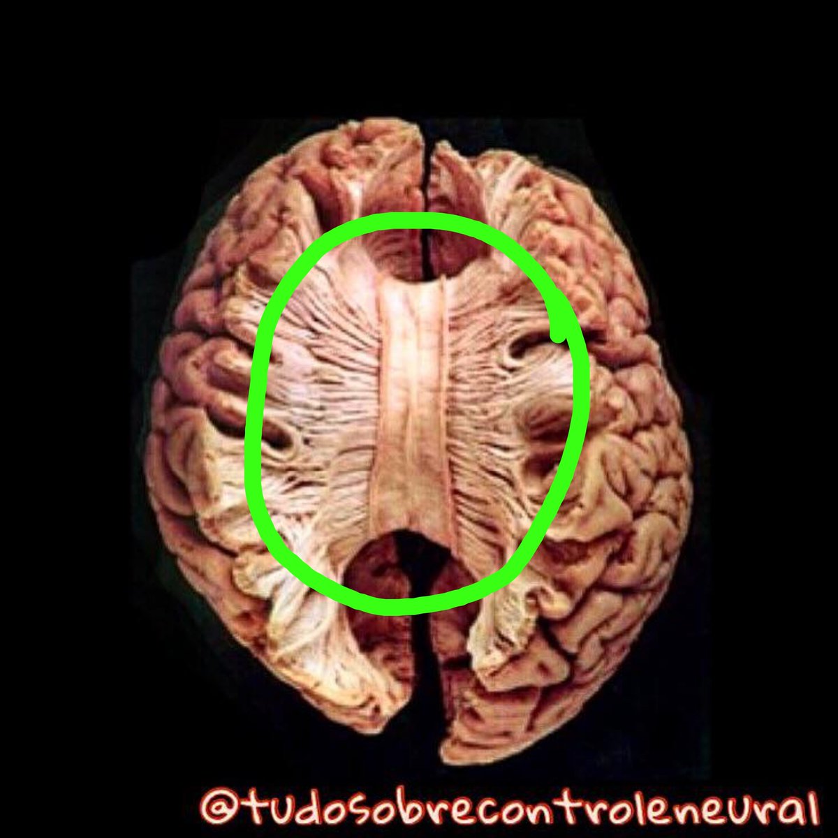 devpaulao's tweet photo. @falaroge E o corpo caloso é o nervo que liga os dois hemisférios do cérebro, por onde passam as fibras q ligam os neurônios de um lado pro outro... Perdi milhares de  neuronios com isso... https://t.co/6DTFAtDO9t