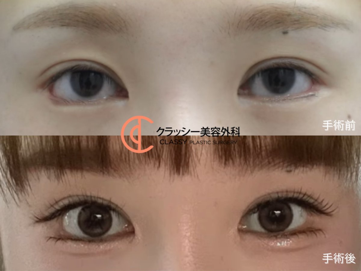 classypsjapan's tweet photo. 🧡MADE IN CLASSY🧡
📝切開法＋目つき矯正＋目頭上切開（術後2か月）

重たく感じていた目元がくっきりとし、
上まぶたのラインまでスッキリと見えることで、
印象が柔らかく変わりました💫

🔗お問合せはプロフィールの公式LINEへ
＃二重整形 #韓国美容 https://t.co/RmNV6UeGSF