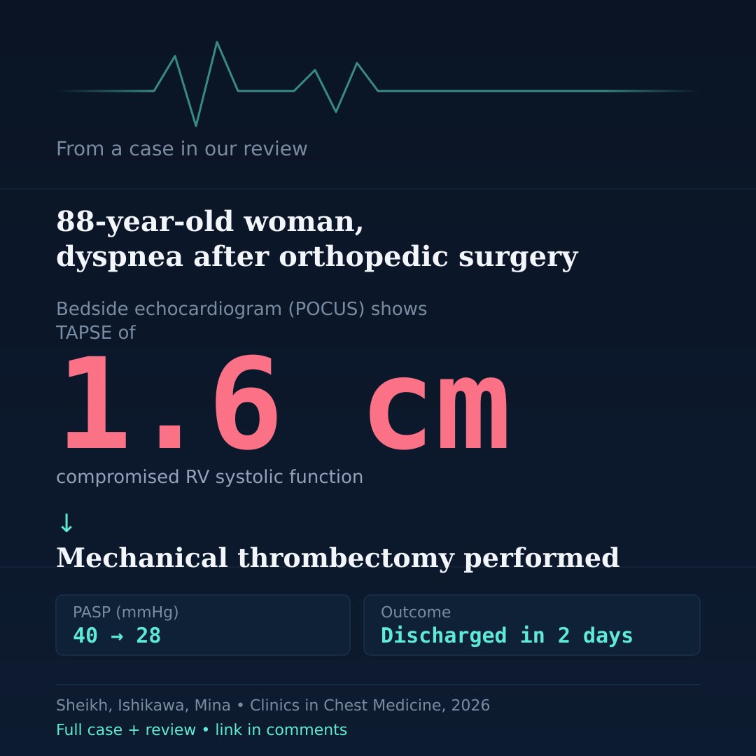 sheikh_asad95's tweet photo. An 88F comes in short of breath after ortho surgery. Vitals look okay. Cardiac enzymes aren't dramatically up. CT: extensive bilateral PE.

A bedside echo tells a very different story. 🧵 https://t.co/93bIAW2tAu