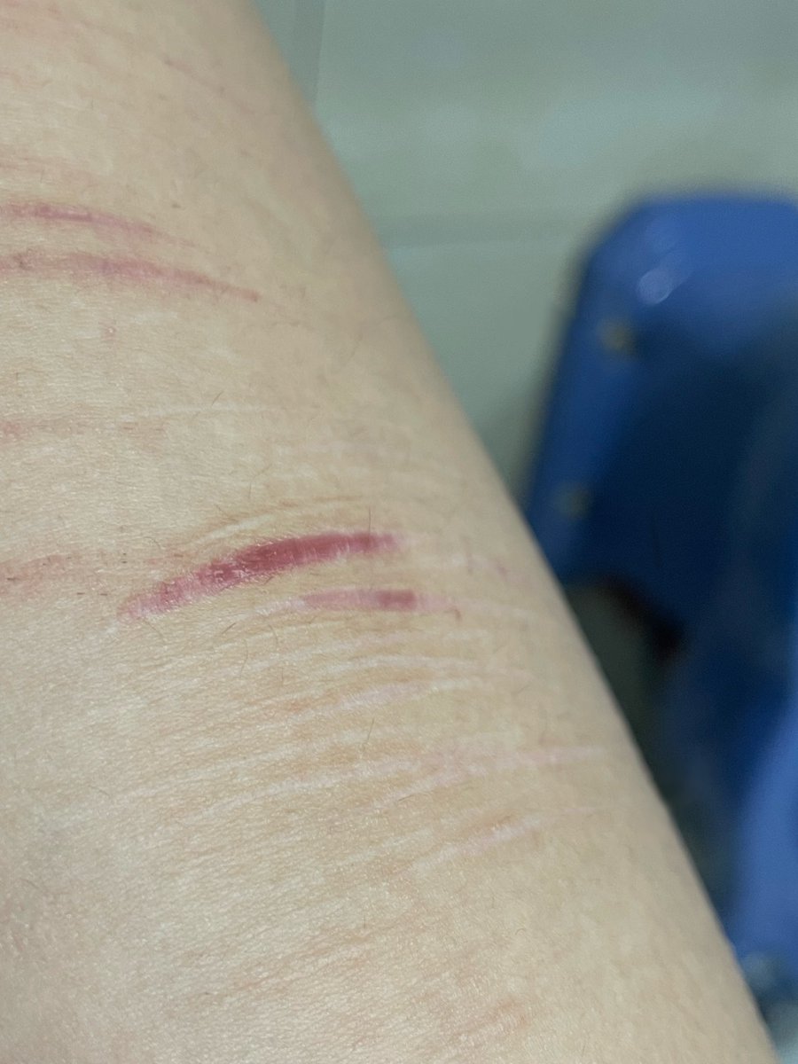 kindeadepressed's tweet photo. for anyone wondering (no one) this is the scar I was talking about

ALL SFX MAKEUP!!! AI GENERATED #scarspo #shtw #slittw #shedtw https://t.co/WWvjYCeZzS