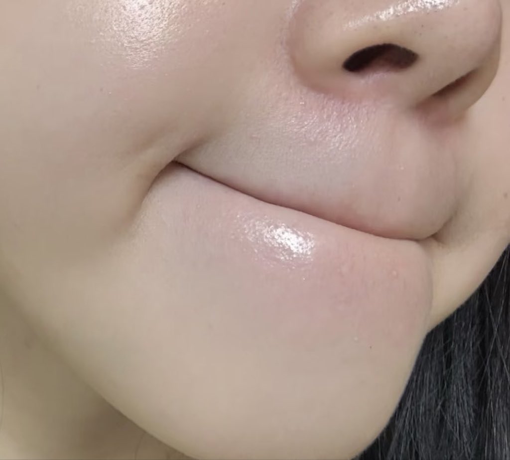 Rin_ka_0011's tweet photo. 前にXで角栓取れるって鬼バズしてたけど、顎下のチキンスキンもごっそり取れて今これ。 https://t.co/PVGoztYzU5