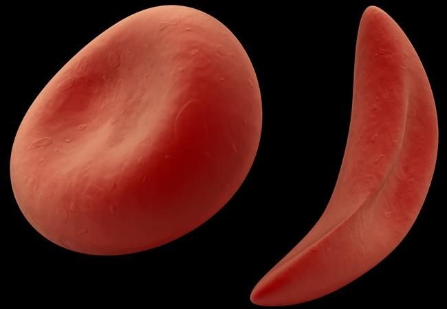 LindAlliance's tweet photo. This #SickleCellAwarenessMonth, we encourage researchers and funders to use the Sickle Cell Genomics PSP priorities to shape future research.

🌟Identified by people with lived and professional experience, they highlight the questions that matter most: https://t.co/pO5mMi60sx https://t.co/Pu6Rh2SdZN