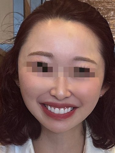 歯の白さと整ってるのが笑った時に1番大事じゃない？歯並びはいいけど形と色に悩んでる人は絶対ラミネートベニヤがおすすめ！2ヶ月もしないうちに完成したし、5年経った今でもやってよかった。 https://t.co/7j5qFGpXPu