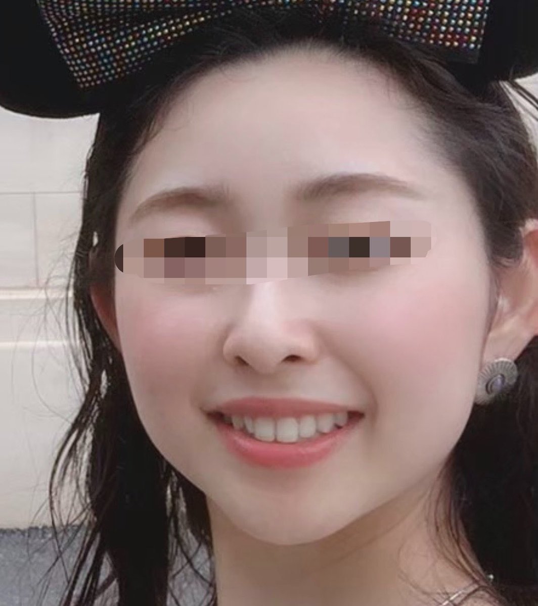 歯の白さと整ってるのが笑った時に1番大事じゃない？歯並びはいいけど形と色に悩んでる人は絶対ラミネートベニヤがおすすめ！2ヶ月もしないうちに完成したし、5年経った今でもやってよかった。 https://t.co/7j5qFGpXPu