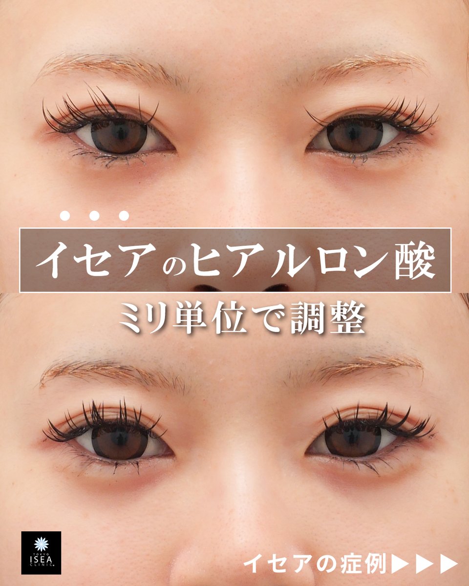isea_case's tweet photo. 涙袋ヒアルロン酸　　
執刀医：大山希里子

Before：術前
After：１週間後

■注入治療Instagram
https://t.co/YmCrDcgRDf

■大山 希里子医師Instagram
https://t.co/kO01xm6G36

■注入サイト(ヒアルロン酸・ボトックス)
https://t.co/AHtOOB456t

■リスク
アレルギー　動脈塞栓　感染など

■料金
1本　¥77,000 (税込)