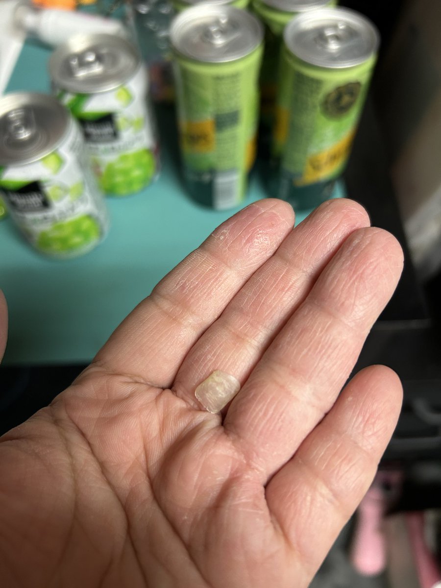 ai_lenkun's tweet photo. 爪が剥がれた……

クソ痛い😭

剥がれ中も引っかかるだけで悲鳴もの……

娘の手足口病移った時に
病院の先生が爪剥がれるとは聞いてたがクソ取れるの遅いし痛い😭

グロくってすまぬ🙇‍♀️ https://t.co/Mj2tE3n6nN