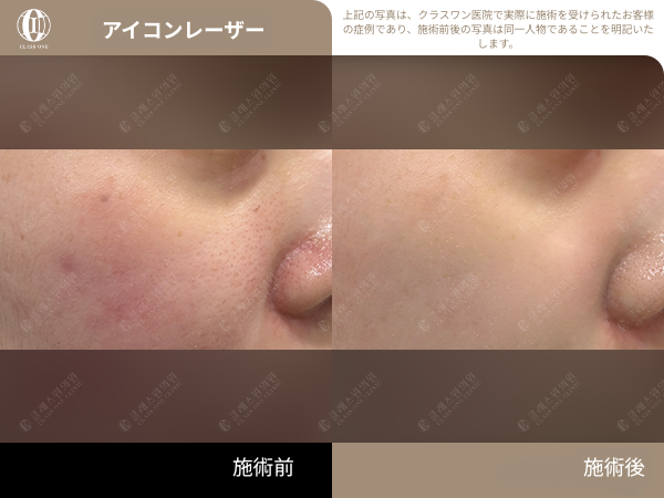 KBGGORG's tweet photo. 【CLASSONE｜ICONレーザー（ICON XD）症例】

気になる毛穴をCLASSONEで✨
肌の変化を、症例写真でチェックしてみてください。

※施術効果・経過には個人差があります。
※施術後、赤み・あざ・腫れなどが生じる場合があります。施術前に医療スタッフへご相談ください。 https://t.co/wTpFulWNfb