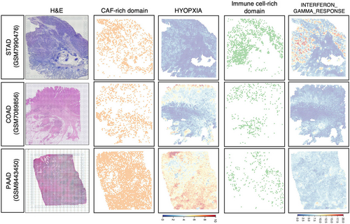 jcaopl's tweet photo. ✨#CancerScience 9/2026 ハイライト論文紹介✨

Organ-Specific Cancer-Associated Fibroblast Subtypes Across the Digestive System Linked to Cancer Hallmarks

Huaitao Wang1,2,3, Takatsugu Ishimoto1,4

1: Division of Carcinogenesis, The Cancer Institute, Japanese Foundation for Cancer Research, Tokyo, Japan
2: Department of Gastroenterological Surgery, Graduate School of Medical Sciences, Kumamoto University, Kumamoto, Japan
3: Department of General Surgery, Shengjing Hospital of China Medical University, Shenyang, China
4: International Research Center of Medical Sciences, Kumamoto University, Kumamoto, Japan

がんの進行はがん細胞だけでなく、周囲の腫瘍微小環境にも大きく影響を受けます。その中でもがん関連線維芽細胞（CAF）は、がんの進展、免疫応答、治療抵抗性において多様な役割を果たしていますが、消化器がん全体におけるCAFの不均一性、組織特異性および臨床的意義については、いまだ十分に明らかにされていません。
そこで本研究では、胃・大腸・膵臓・胆道がんを含む消化器がん239例を、単一細胞解析、機械学習、空間マッピング技術を用いて詳細に解析しました。その結果、8つのCAFサブタイプが同定されました。このうち筋線維芽細胞性CAFの2つのサブタイプmyCAF1とmyCAF2は予後不良と強く関連し、組織リモデリングや低酸素適応、免疫抑制性マクロファージとの相互作用を特徴としていました。一方、炎症性CAFであるiCAF1は予後良好と関連し、抗腫瘍性免疫細胞が多く存在することが明らかとなりました。
消化器がんでは臓器ごとにCAFの構成が大きく異なり、CAFの多様性と局在が病態に深く関与することが示されました。今後は有害なサブタイプを選択的に標的とし、有益なものを温存または促進する精密な治療戦略が重要になると考えられます。

📄論文URL
https://t.co/5HSrEQdqZ7

📖In this issueのURL
https://t.co/B6AWE83GOD

#gastrointestinal_cancer #cancer_associated_fibroblast #CAF #myCAF1 #myCAF2 #iCAF1 
#日本癌学会 #JCA #がん研究