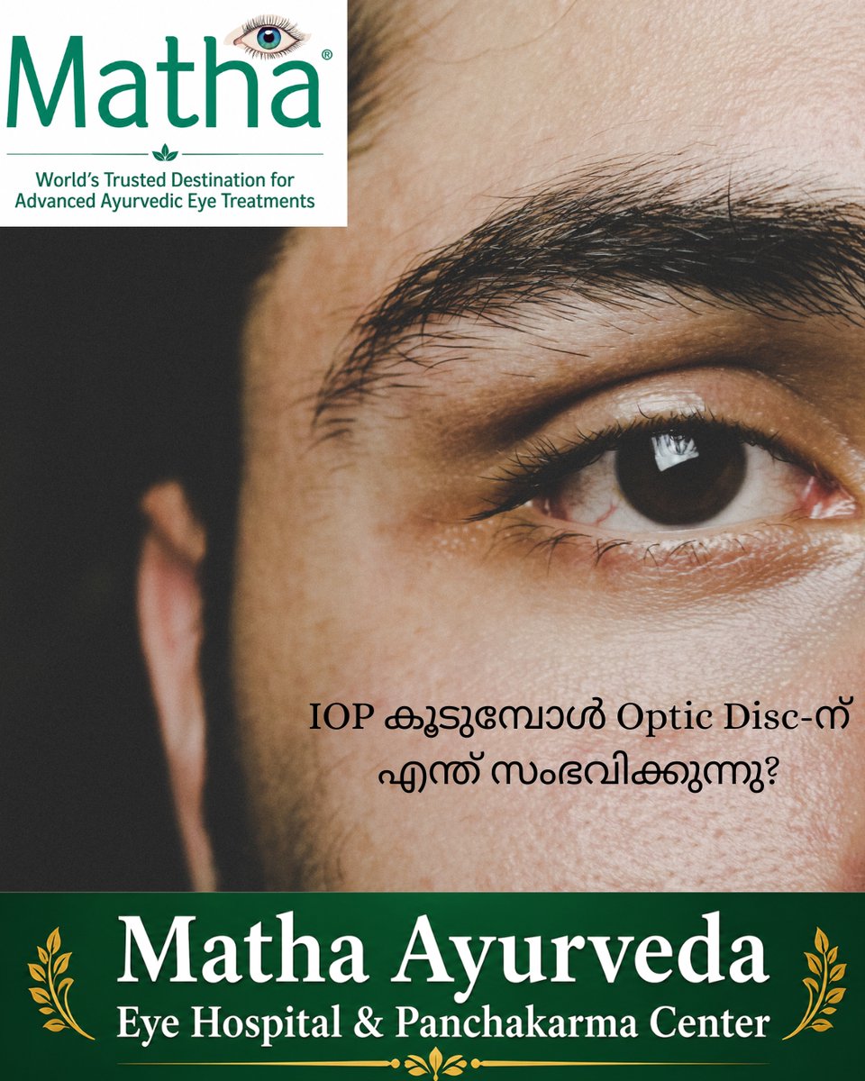 arunjithp's tweet photo. കണ്ണിനുള്ളിലെ pressure — IOP (Intraocular Pressure) — കൂടുമ്പോൾ, അത് Optic Disc / Optic Nerve Head-ൽ സമ്മർദ്ദം ഉണ്ടാക്കാം.

ഈ സമ്മർദ്ദം ദീർഘകാലം തുടരുമ്പോൾ optic nerve fibres ക്രമേണ damage ആവുകയും optic disc cupping വർധിക്കുകയും ചെയ്യാം. ഇതിന്റെ ഫലമായി കാഴ്ചയുടെ പരിധിയായ Visual Field ക്രമേണ കുറയാനുള്ള സാധ്യതയുണ്ട്.

അതുകൊണ്ട് Glaucomaയിൽ IOP മാത്രം അളക്കുന്നതല്ല, Optic Disc-ന്റെയും Optic Nerve-ന്റെയും അവസ്ഥയും കൃത്യമായി വിലയിരുത്തേണ്ടത് പ്രധാനമാണ്.

Click here to watch>>>https://t.co/cC1ipzAnGB