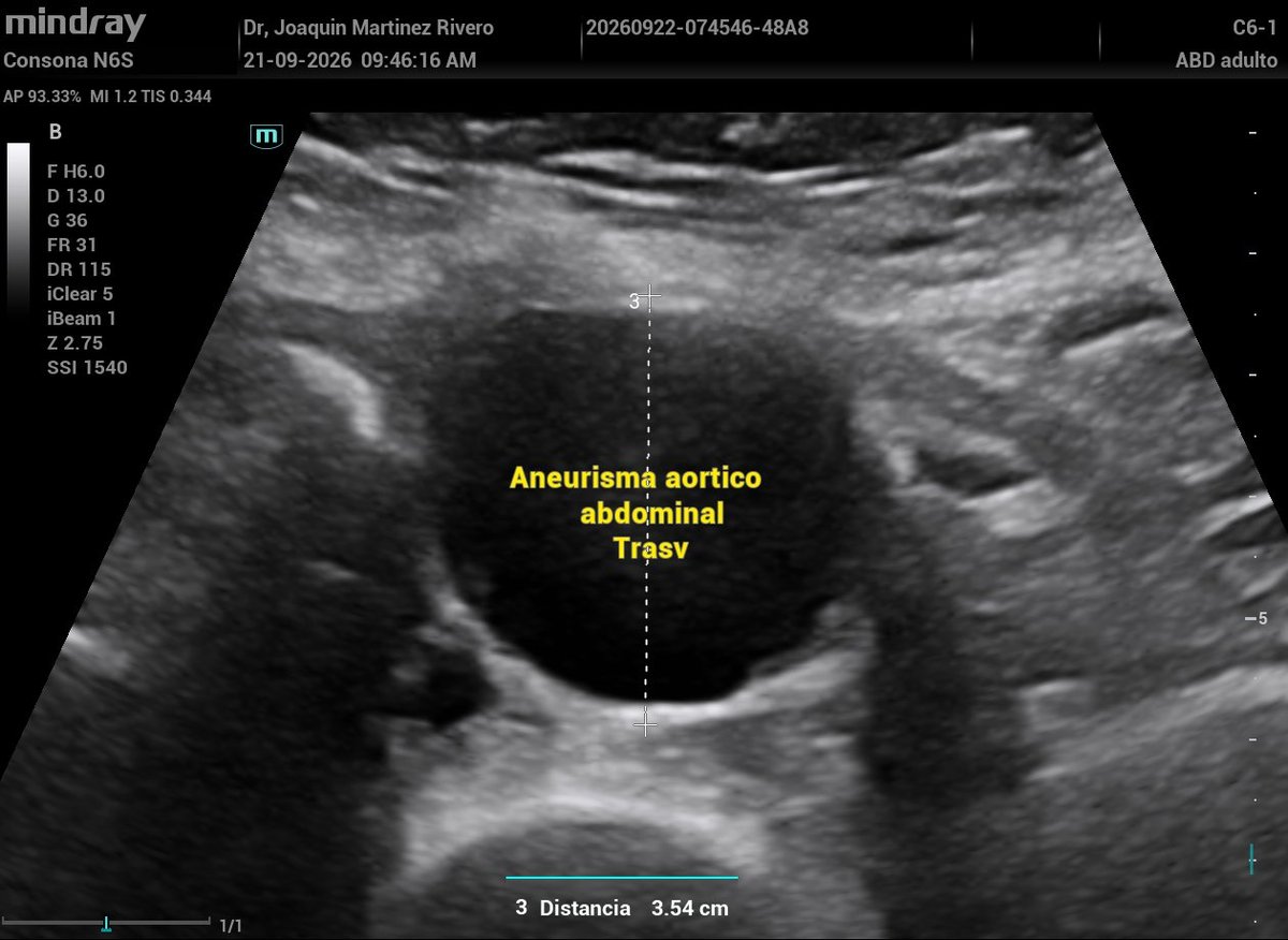 JMMR83's tweet photo. Aneurisma aórtico abdominal infrarrenal. https://t.co/dLrGOEs4zC
