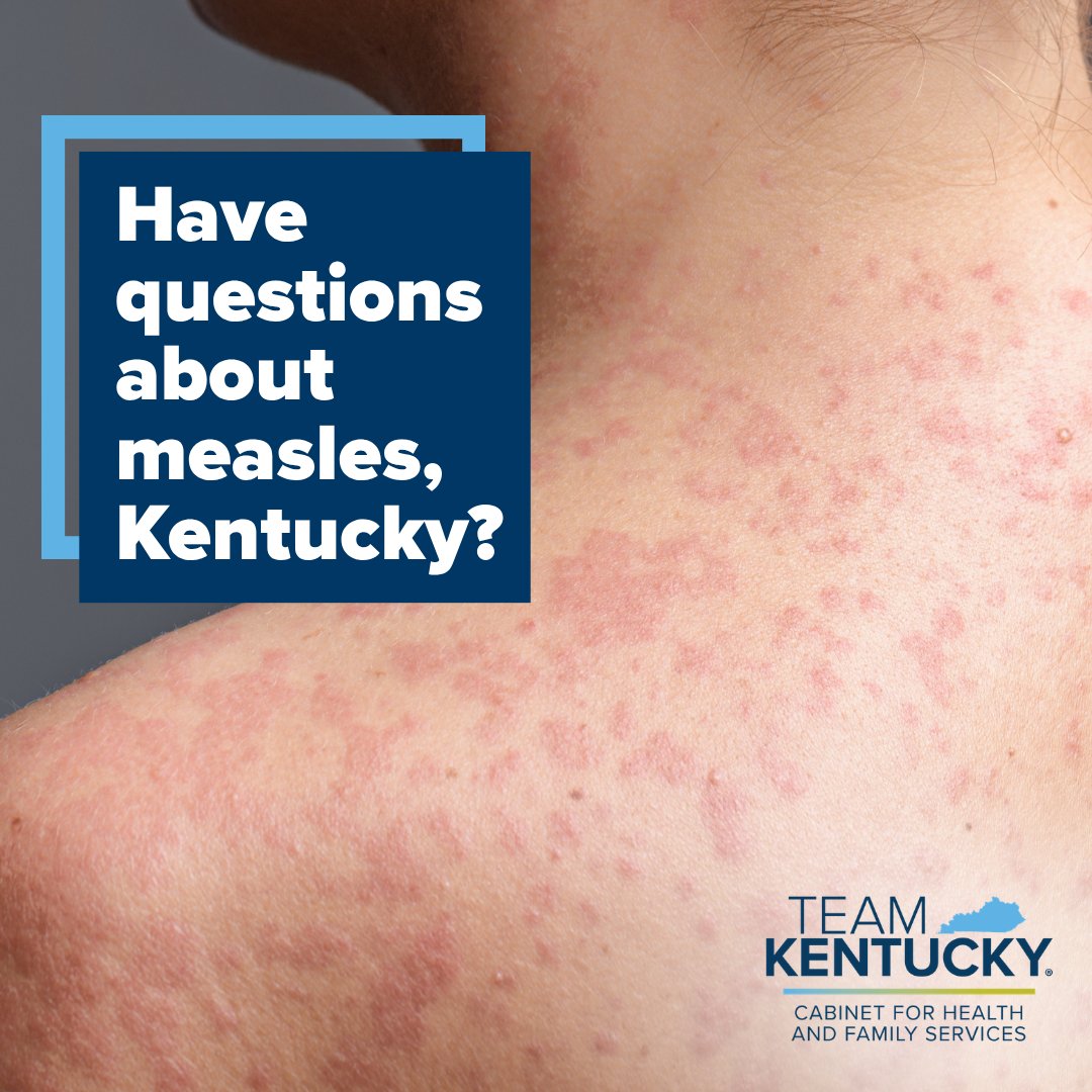 CHFSKy's tweet photo. Vaccination is the most effective way to prevent measles. People who have symptoms or medical concerns about measles should contact their doctor or other healthcare provider. Learn more about measles in Kentucky at this website: https://t.co/sAGtbOgEQ2 https://t.co/oPB0Gz3ttJ