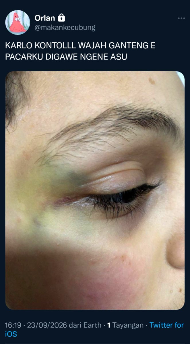 LN1lovemakerr's tweet photo. TW // BRUISES!! https://t.co/8Fz4vVqW9r