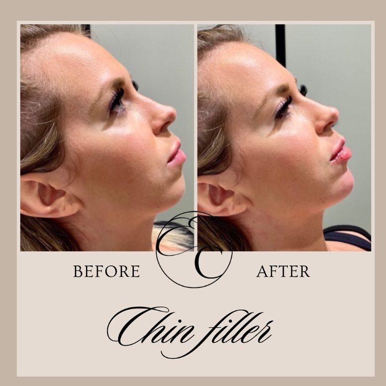 EnhanceClinicBe's tweet photo. 𝐂𝐡𝐢𝐧 𝐟𝐢𝐥𝐥𝐞𝐫 💉

1ML filler in the chin for this beauty!
Visit: https://t.co/6dB9J2u01O
🕣 Appointment time: 20 min
🤕 Downtime: Bit of swelling and bruising can accur, allow two weeks to fully settle.

#enhanceclinic #aesthetic #ghent #botox #beauty #fillers https://t.co/IzfMhWgZBk