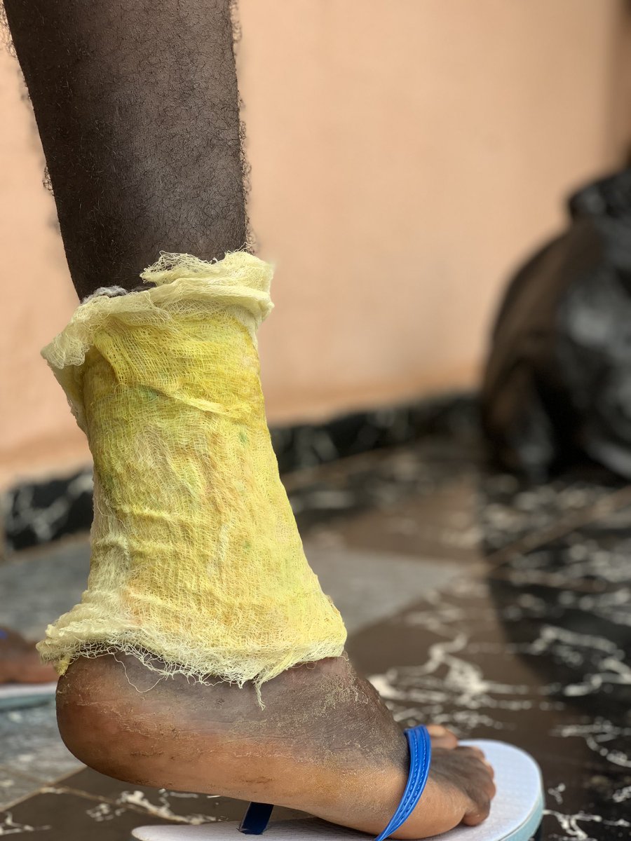 OmejeChiamaka's tweet photo. Please help save my brother, Ugo. 

My name is Chiamaka, and I am raising this campaign to ask for help for my brother, Ugonna Omeje, who lives with sickle cell disease and needs urgent medical care for a deteriorating leg ulcer. https://t.co/2AwCIilFmE