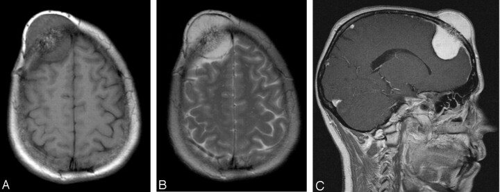 DocNavarrow's tweet photo. 👩46-year-old woman with a painless, gradually enlarging bony-hard forehead mass causing cosmetic deformity, with normal overlying skin and no other symptoms. 

🧑‍⚕️What is your differential diagnosis? https://t.co/zaJH3ou4k5