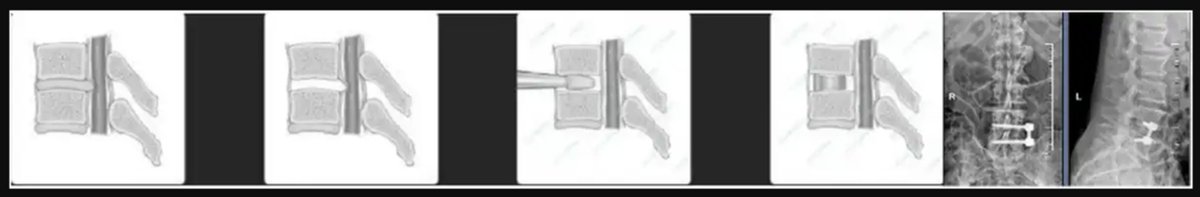 NeurosurgeryCNS's tweet photo. #NEUNew Oblique Lateral Interbody Fusion With Lateral Vertebral Screw Fixation Versus Transforaminal Lumbar Interbody Fusion for Severe Lumbar Stenosis: Results of a Multicenter Randomized Controlled Trial https://t.co/8Wuow1SirQ by Li et al at the Hospital of Soochow University https://t.co/lLGktLxjBP