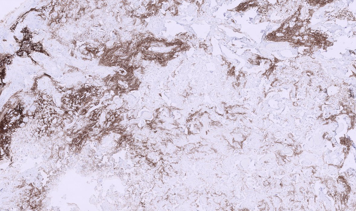 PeterKobalka's tweet photo. One might think a vascular malformation at LP. Zoom in and you’ll see pockets of meningothelial cells. This architecture is characteristic of the angiomatous pattern of meningioma. SSTR2A is + #Pathtwitter #Pathx #Neuropath #Neuropathology #Pathology #CNSPathology https://t.co/725dwehTbp