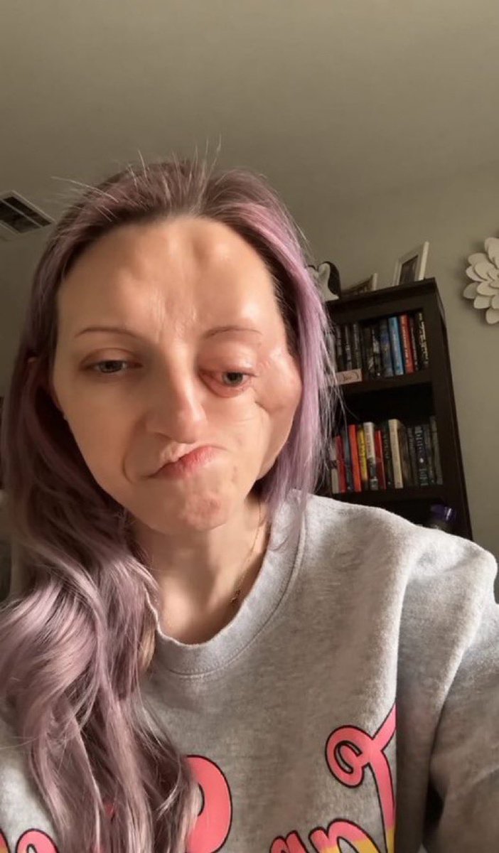 Natalie9c's tweet photo. Face cancer has changed my life, and every day is a difficult fight.

🙏 Please support my treatment or share my story. Every bit of help gives me hope. ❤️ https://t.co/cL383RHlzn