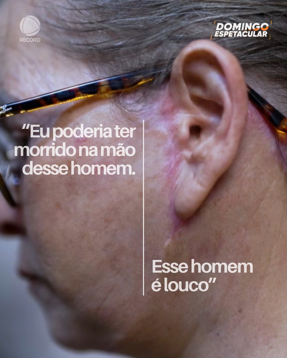 DomEspetacular's tweet photo. “PODERIA TER MORRIDO” | Pacientes que passaram por cirurgias plásticas com André Lançoni da Costa relatam complicações graves e sequelas. “Fiquei mutilada”, desabafa Indiamara Alves de Souza, que passou por cirurgias na barriga e nos seios. Outra paciente afirma: “Esse homem é louco.”

Além das mulheres que dizem ter ficado com deformações e outros problemas após os procedimentos, o #DomingoEspetacular também ouviu a família de uma paciente que morreu depois de cirurgias realizadas pelo médico. O cirurgião teve o registro profissional cassado pelo Conselho Federal de Medicina, mas novas denúncias surgiram mesmo depois da decisão.

➡️ A reportagem completa você encontra em: https://t.co/1LiryZ3s9Y
#ReportagensDE #RECORD