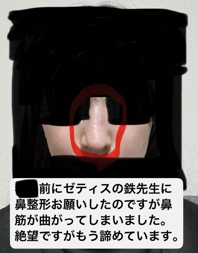 tokyo_moccorys's tweet photo. 改めて、ゼティスビューティークリニックの鉄先生の手術は酷いぞ。この子の鼻なんて素人が見たって一目で失敗してることが分かる。鼻を綺麗にしに行ったのに、逆にひん曲げられて223万も取られたら、そりゃ人の恨みも買うわな。道理で情報が集まるわけだ。 https://t.co/woclB8onML