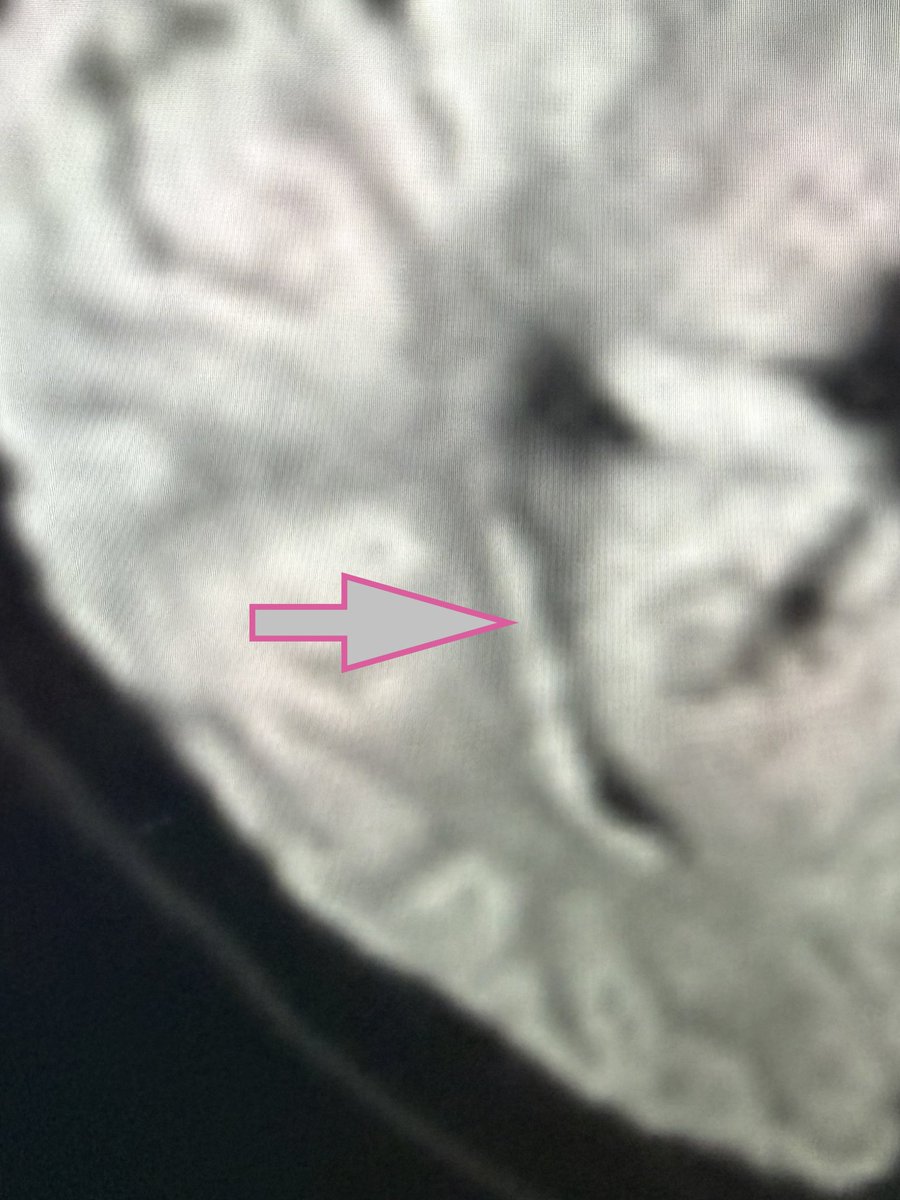 drmankad's tweet photo. Top tip 💡: Yet another use of diffusion weighted imaging- the easier detection of periventricular grey matter heterotopia- if you missed it on the thick axial T2, stop by on the DWI and track back. 

Below, first image- DWI. https://t.co/KWszFCqCxZ