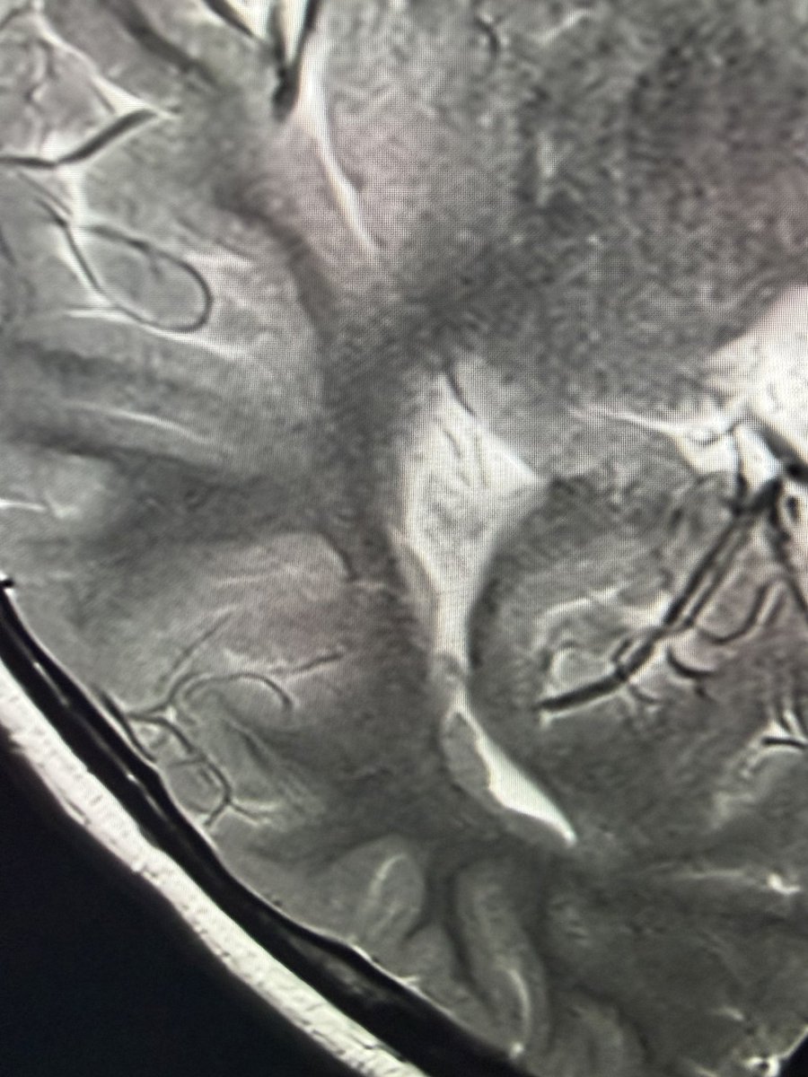 drmankad's tweet photo. Top tip 💡: Yet another use of diffusion weighted imaging- the easier detection of periventricular grey matter heterotopia- if you missed it on the thick axial T2, stop by on the DWI and track back. 

Below, first image- DWI. https://t.co/KWszFCqCxZ