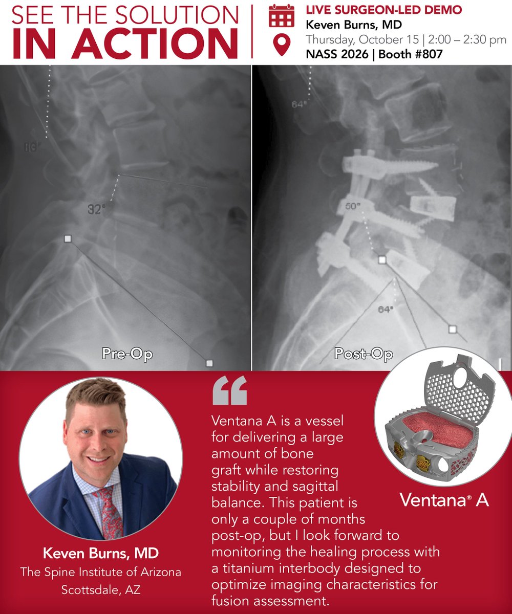 SpinalElements's tweet photo. See Ventana® A in action at NASS 2026. 
Join us at Spinal Elements Booth #807 for a live surgeon-led demonstration with Keven Burns, MD, as he shares his clinical perspectives on Ventana A.
- Thursday, October 15 | 2:00–2:30 PM
- NASS 2026 | Booth #807 https://t.co/3uLqJ4F73c