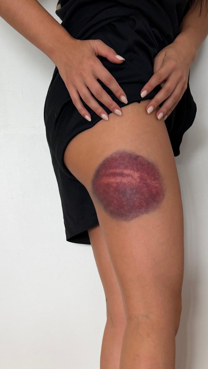 Marilynlynlyn_'s tweet photo. @IamRGR1 A mí hoy me cuesta caminar después de los golpes que me dieron ayer los mismos policías que le pegaron a @_PabloFdez_, pero por más que quieran los de @JupolNacional, lo que no vamos a hacer es quedarnos en nuestras casas amedrentadas por su violencia. Seguimos ✊ https://t.co/RyuTUWubak