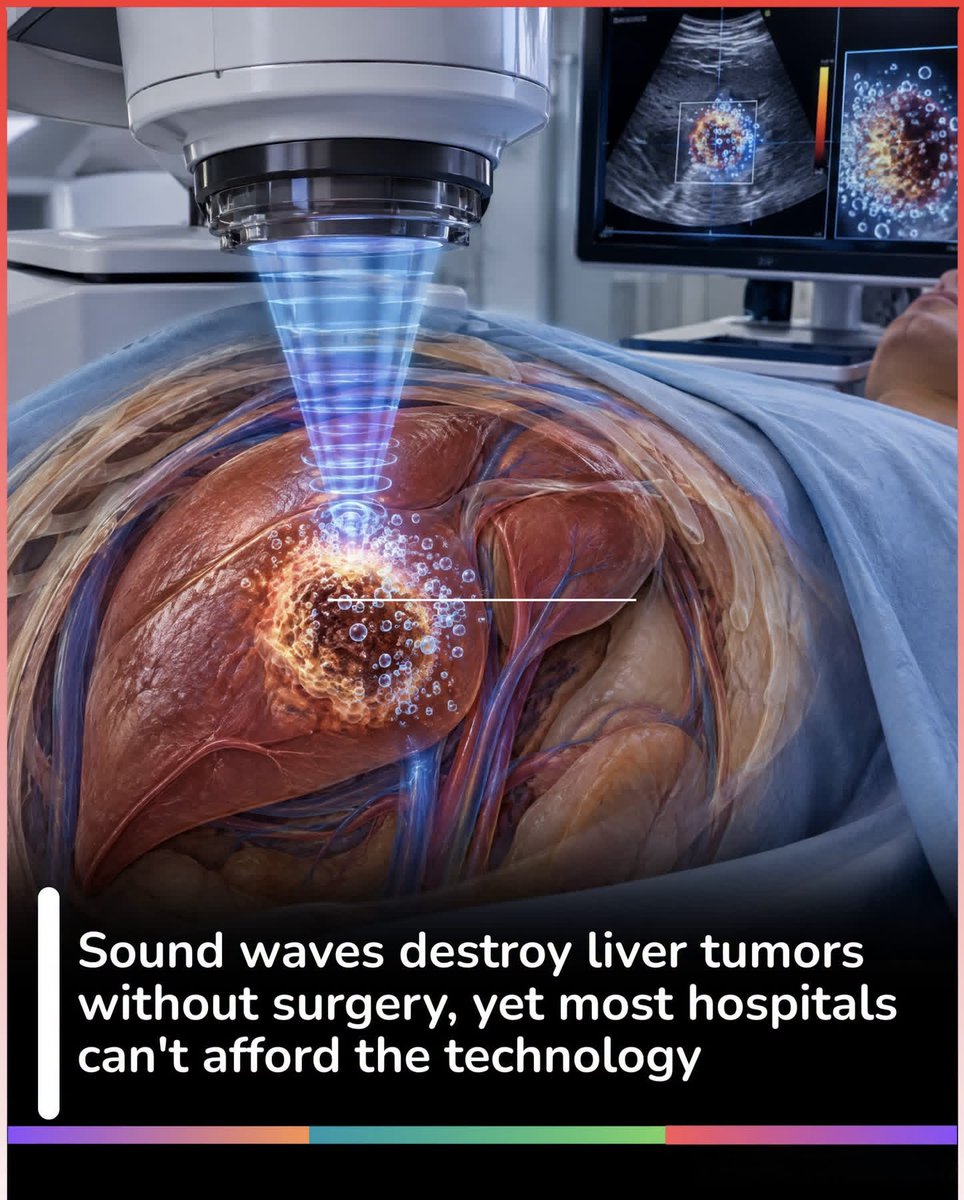 A Cancer Treatment That Uses Sound Instead of Surgery
Imagine destroying a liver tumor without an incision, radiation, or heat.
That is the idea behind histotripsy. The FDA cleared the HistoSonics Edison system in 2023 for non-invasive destruction of liver tumors. Focused sound waves create tiny bubbles that mechanically break apart targeted tissue.
Early studies are promising, but this is not a cure-all, and access remains limited to hospitals offering the technology.
A remarkable example of how sound waves are entering cancer treatment. 
Source: U.S. Food and Drug Administration.  HistoSonics Edison System 510(k) clearance.