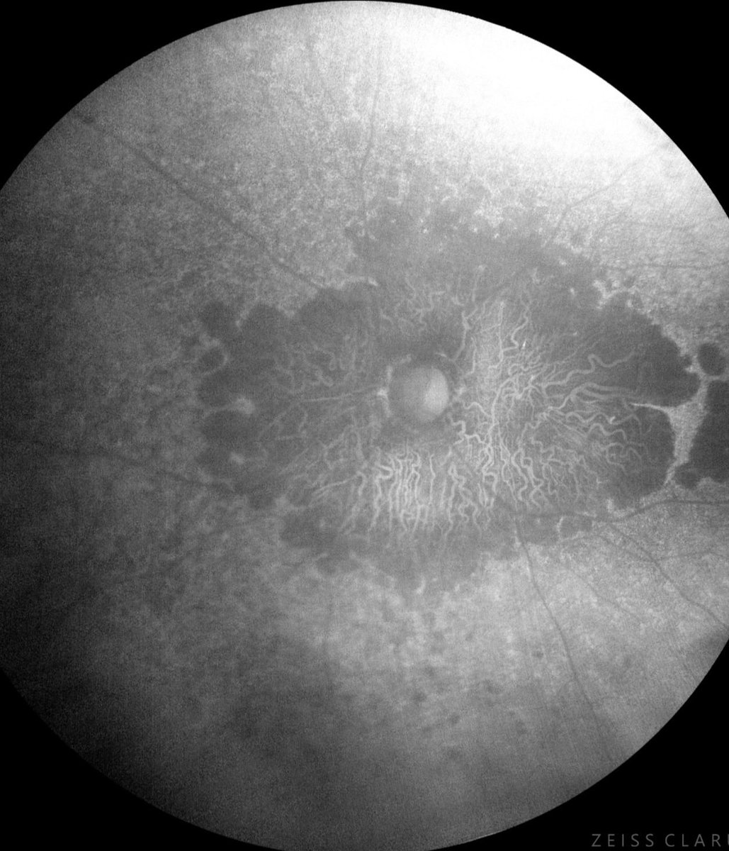 aecrceye's tweet photo. 👁️✨ Did you know about Bietti Crystalline Dystrophy (BCD)?
It is a rare, inherited eye disease characterized by the buildup of tiny, sparkling yellow-white crystals in the retina and cornea. @ASRSdoc @RetinaSociety @aao_ophth @NEI_NIH #Retina #RareDisease #Genetics #BCD https://t.co/8HtLVEjnYt