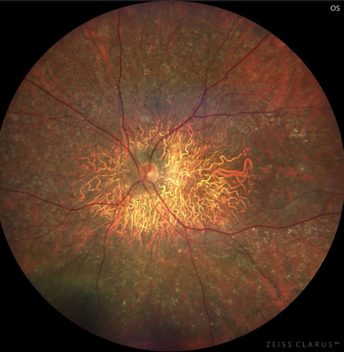 aecrceye's tweet photo. 👁️✨ Did you know about Bietti Crystalline Dystrophy (BCD)?
It is a rare, inherited eye disease characterized by the buildup of tiny, sparkling yellow-white crystals in the retina and cornea. @ASRSdoc @RetinaSociety @aao_ophth @NEI_NIH #Retina #RareDisease #Genetics #BCD https://t.co/8HtLVEjnYt