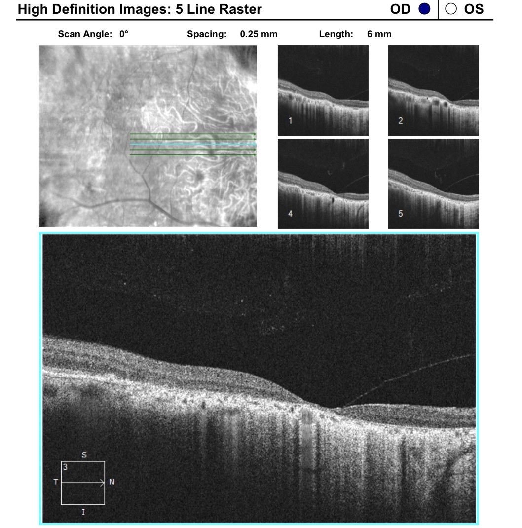 aecrceye's tweet photo. Caused by mutations in the CYP4V2 gene, it progressively leads to night blindness, retinal degeneration, and visual field loss. Early screening with OCT and genetic counseling are crucial for managing this condition! 🧬🔬 @ASRSdoc @RetinaSociety @aao_ophth @NEI_NIH @ARVOinfo https://t.co/5SqiNxdgCi