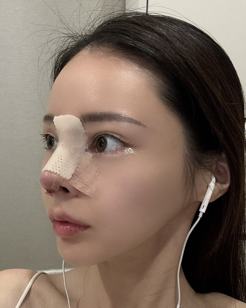 miyubebexx's tweet photo. 鼻フル再手術DT0日目👃
15時頃オペ開始→お越しに来てもらったのに19時前まで寝てしまってた🫨
あまりにも腫れてなくて神すぎるし、口呼吸想定だったけど鼻も通るので明日は美味しいもの食べる❤︎ https://t.co/exFBREiaiu