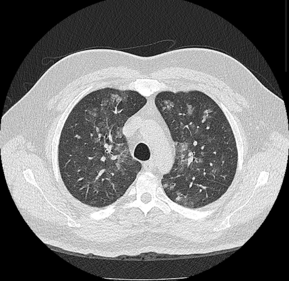 radiology2022's tweet photo. コカイン中毒の画像診断
✅頭部：脳梗塞・脳出血・SAH・RCVS・PRES
✅胸部：crack lung（両側GGO）、肺胞出血、気胸
✅腹部：腸管虚血、腎・脾梗塞
💡若年者の原因不明な血管イベントでは薬物使用も鑑別に。

#rdiag https://t.co/VfWvFRywKj