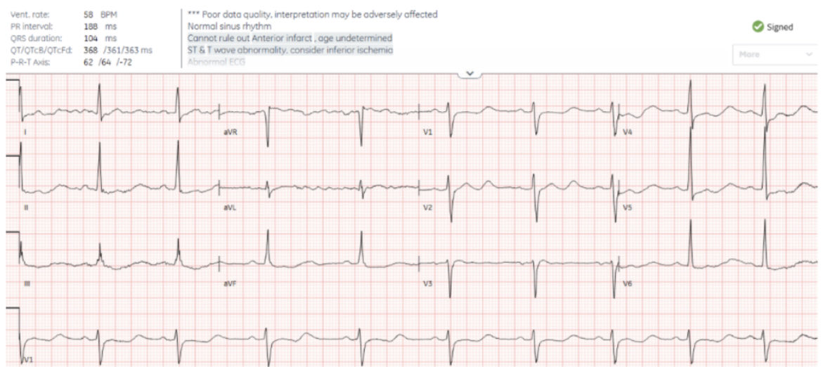 heartsECGcourse's tweet photo. 50 year-old with weakness. Is this ischemia? 

#ECG #EKG #cardiotwitter

https://t.co/tWUvcpVkp7 https://t.co/0ffOQS4dU1