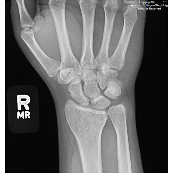 X-ray image of a right wrist showing bones in black and white. "R MR" is labeled on the left side. Image is copyrighted by the American College of Radiology.