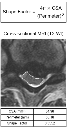 JournalSCI's tweet photo. This study investigated the utility of the spinal cord Shape Factor as a preoperative predictor of surgical outcomes in patients with thoracic ossification of the posterior longitudinal ligament.

https://t.co/vtCeZPnyJv https://t.co/8bMhmRYeJj