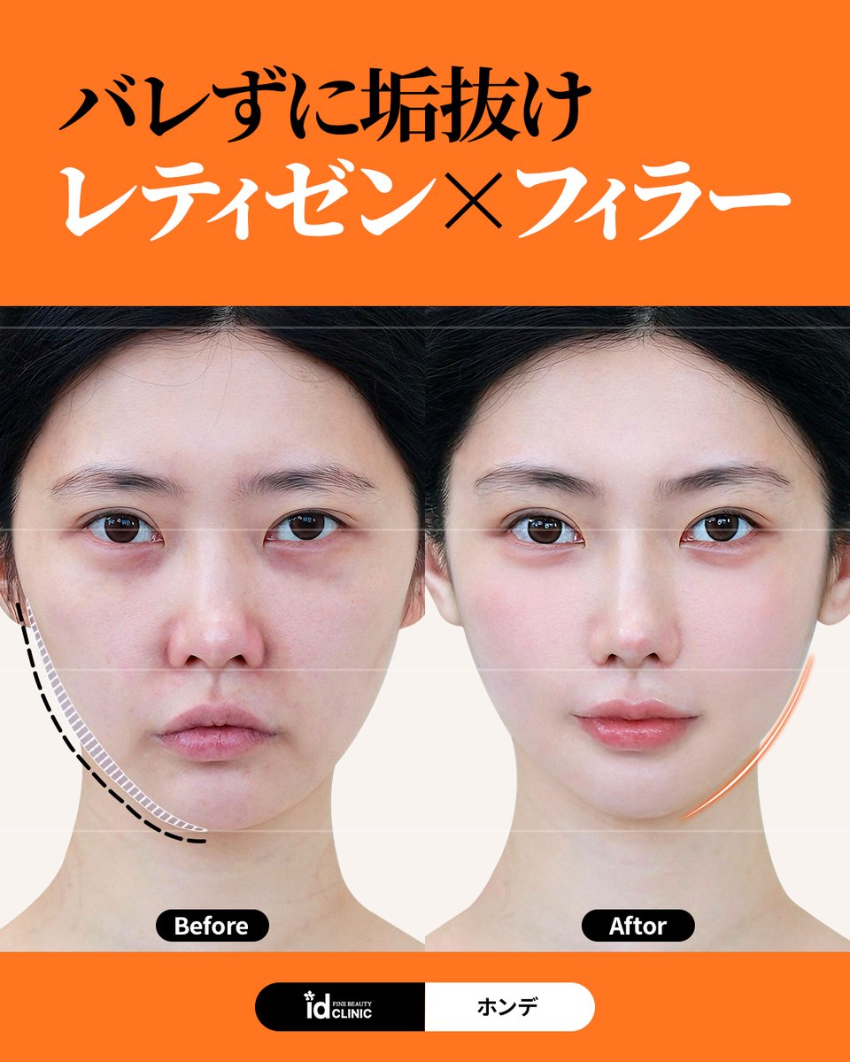 idclinicjp's tweet photo. レティゼン+フィラー｜バレずに垢抜け

🧡垢抜けなら施術を組み合わせ🧡

✔ 疲れてる・老けた印象がお悩み
✔ コラーゲンを直接注入レティゼン
✔ 横頬フィラーで童顔フェイスに
✔選べるフィラーの種類
✔ 自然な変化でバレずに綺麗に🥰

✨ レティゼンキードクター���籍
✨ 日本語対応可

📍 id Clinic 弘大院
📞 ご予約・お問い合わせは、こちらから
https://t.co/vibZORBycc

＃肌管理 #韓国美容 #垢抜け #弘大