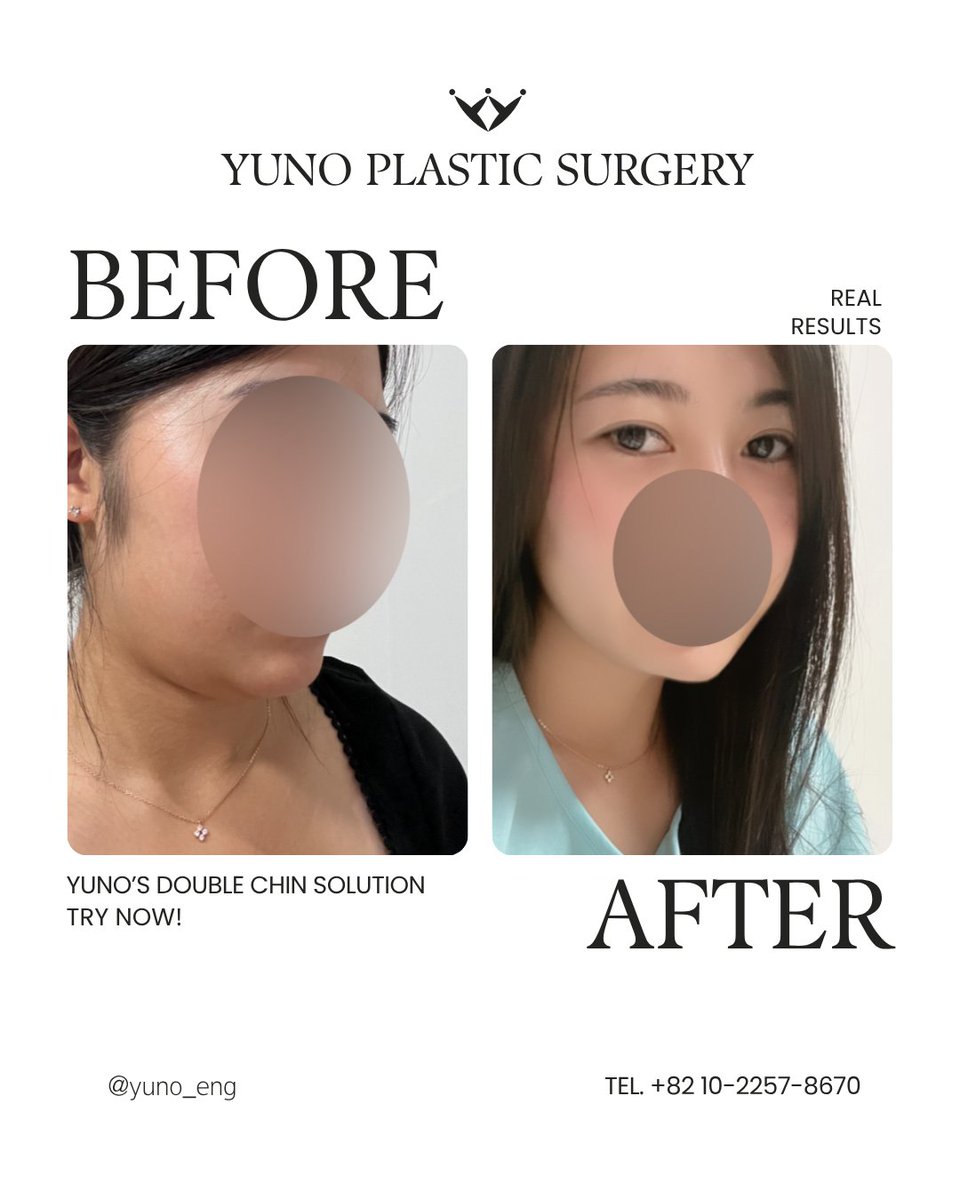 yuno_eng's tweet photo. ✨ YUNO’s Double Chin Solution 

YUNO’s Double Chin Solution is customized to each patient’s facial structure focusing on excess fat and the underlying chin muscle to create a cleaner more defined lower face

📱 Contact Us
WhatsApp: +82 10 2257 8670
💬 KakaoTalk: yuno_ps

#YUNO https://t.co/XIedoNL6rD