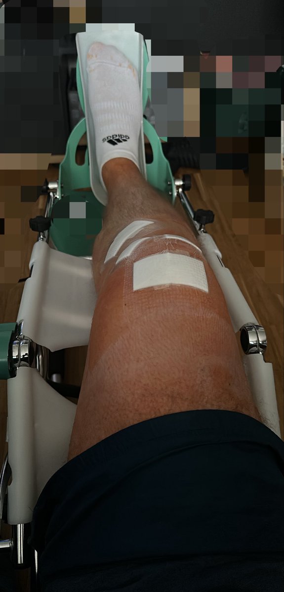Mikemar9x's tweet photo. Den Kreuzer auskurieren. #acl #aclrehab #sport #berufsrisiko https://t.co/XxrC4n8hts
