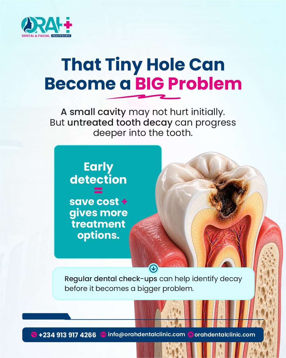 orahdental's tweet photo. A small cavity may not cause pain at first, but that doesn’t mean it should be ignored. 🦷

Tooth decay can progress deeper into the tooth and may eventually require more extensive treatment. Early detection and treatment can help prevent pain and more serious complications. https://t.co/Wca77WEHor