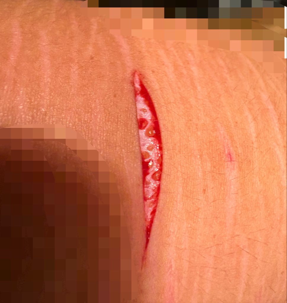 bnanapancke's tweet photo. cut from yesterday!! I think it’s really pretty🧁🧁 #shedtwt #slittwt #ouchietwt
fake fake fake!! sfx makeup! https://t.co/D9lD0HQk3Y